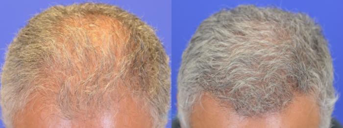 Hair Restoration FUE - Before 
