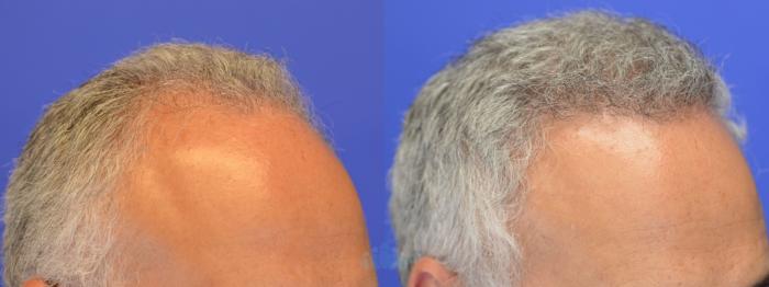 Hair Restoration FUE - Before 