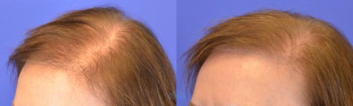 Hair Restoration FUT - Before