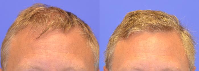 Hair Restoration FUT - Before