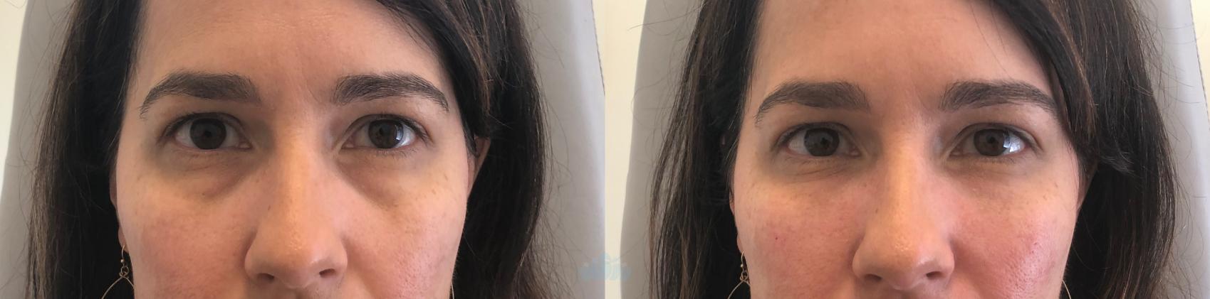 Before & After Juvéderm® & Restylane® Case 25 Front View in Charlotte, NC