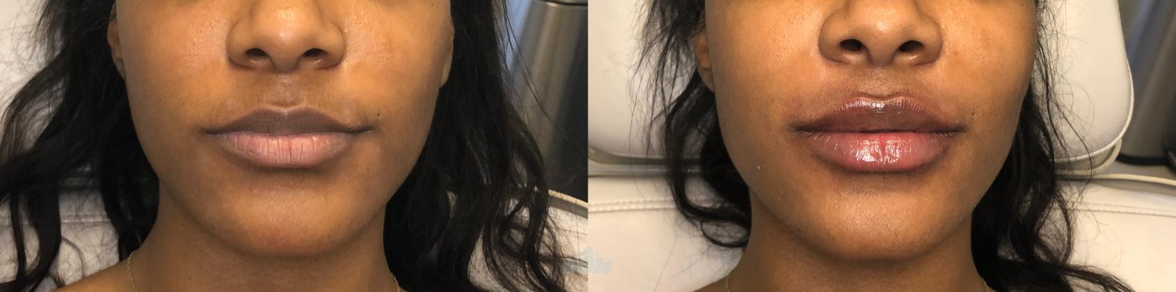 Before & After Juvéderm® & Restylane® Case 26 Front - 2nd view View in Charlotte, NC
