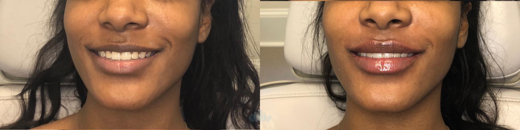 Before & After Juvéderm® & Restylane® Case 26 Front View in Charlotte, NC