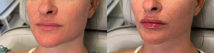 Before & After Juvéderm® & Restylane® Case 27 Front View in Charlotte, NC