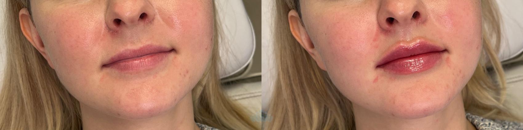 Before & After Juvéderm® & Restylane® Case 29 Front View in Charlotte, NC