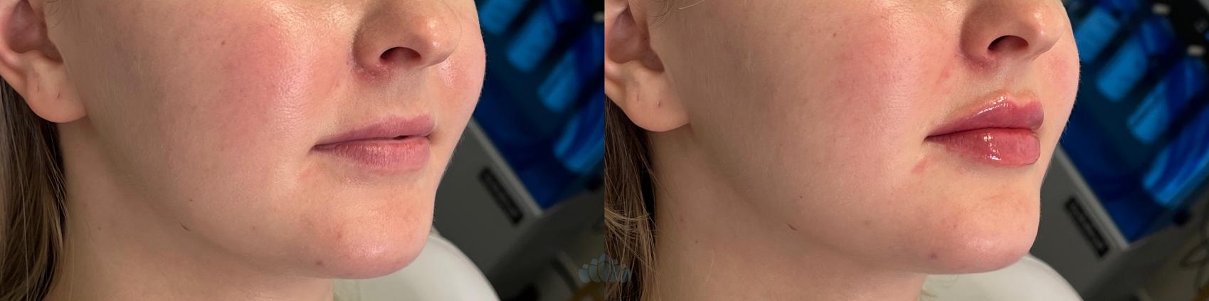 Before & After Juvéderm® & Restylane® Case 29 Left Oblique View in Charlotte, NC