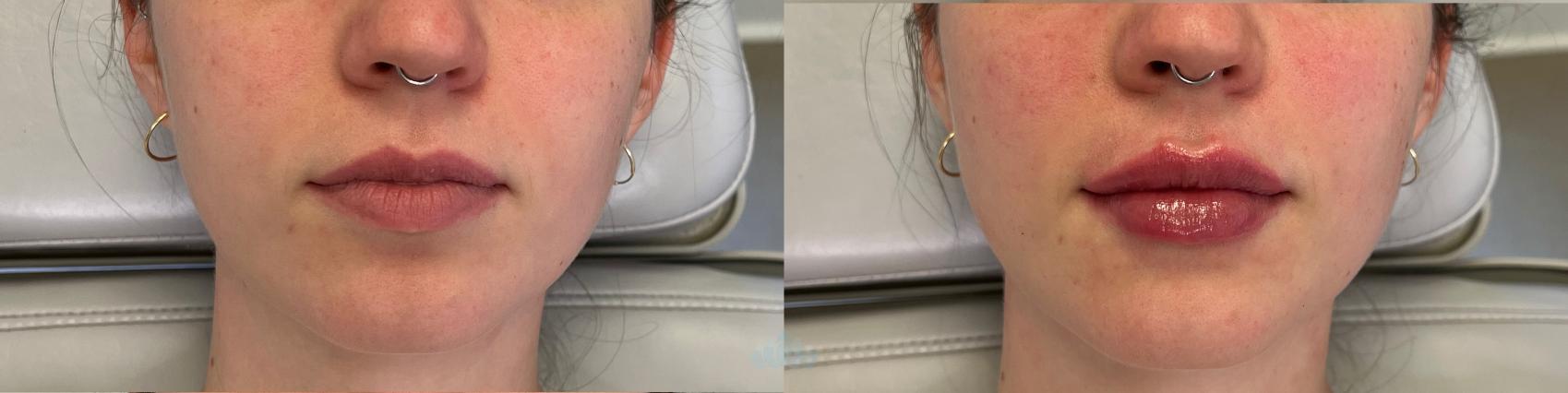 Before & After Juvéderm® & Restylane® Case 30 Front - 2nd view View in Charlotte, NC