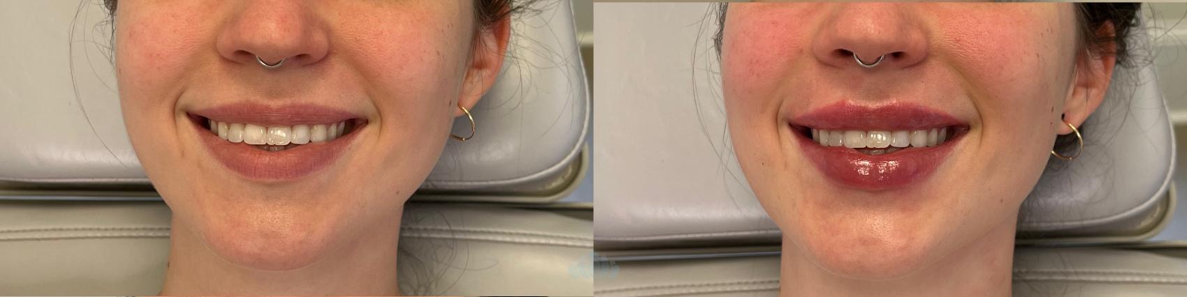Before & After Juvéderm® & Restylane® Case 30 Front View in Charlotte, NC