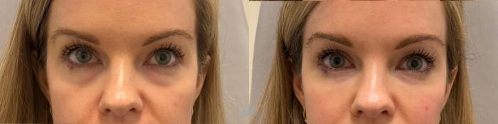 Before & After Juvéderm® & Restylane® Case 31 Front View in Charlotte, NC