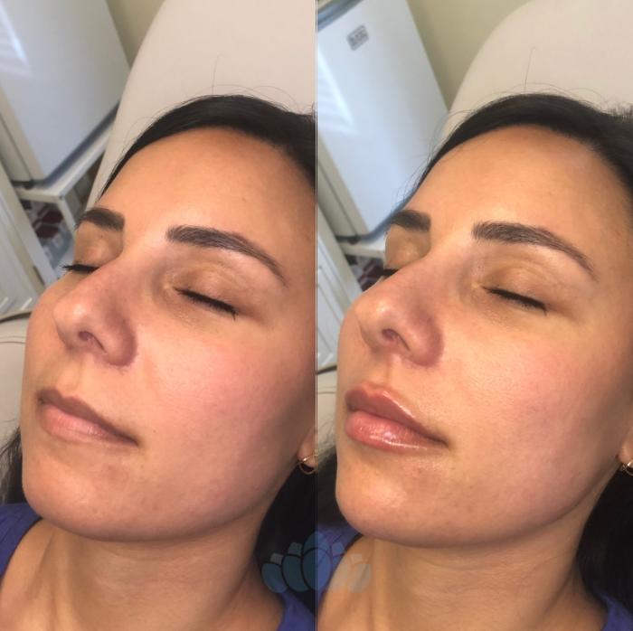Before & After BOTOX® Cosmetic Case 32 Front View in Charlotte, NC