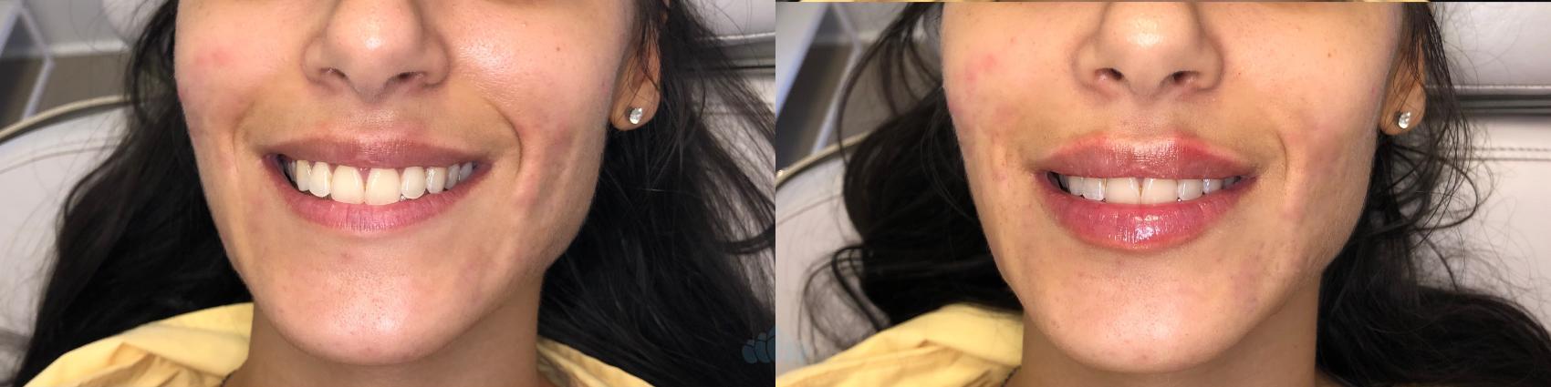 Before & After Juvéderm® & Restylane® Case 33 Front - 2nd view View in Charlotte, NC