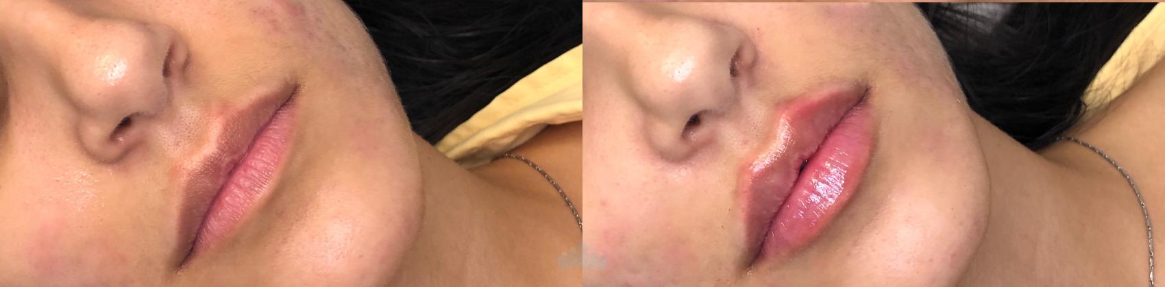 Before & After Juvéderm® & Restylane® Case 33 Front View in Charlotte, NC