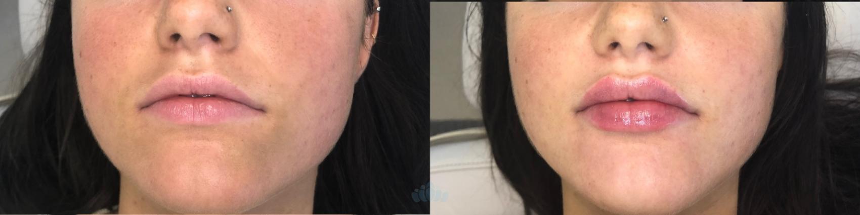 Before & After Juvéderm® & Restylane® Case 34 Front View in Charlotte, NC