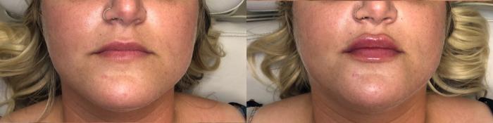 Before & After Juvéderm® & Restylane® Case 35 Front View in Charlotte, NC