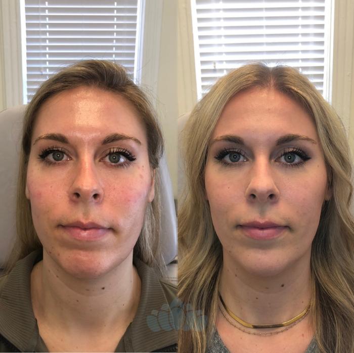 Before & After Juvéderm® & Restylane® Case 36 Front View in Charlotte, NC