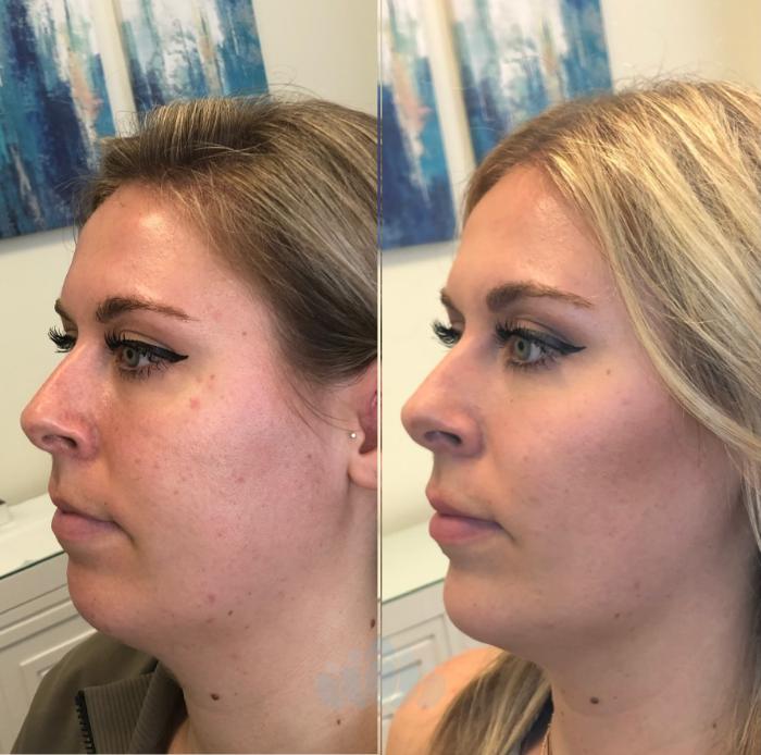 Before & After Juvéderm® & Restylane® Case 36 Right Oblique View in Charlotte, NC
