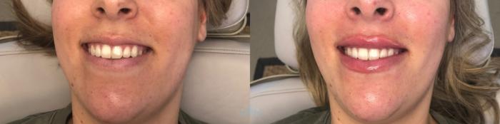 Before & After Juvéderm® & Restylane® Case 37 Right Oblique View in Charlotte, NC