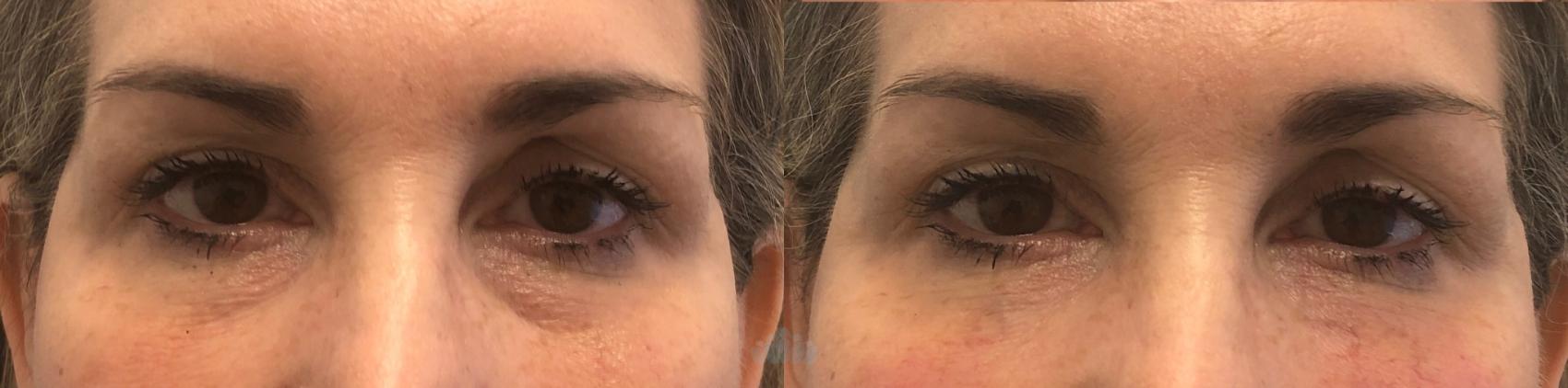 Before & After Juvéderm® & Restylane® Case 38 Front View in Charlotte, NC
