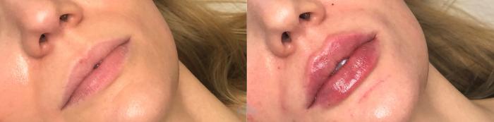 Before & After Juvéderm® & Restylane® Case 39 Front - 2nd view View in Charlotte, NC