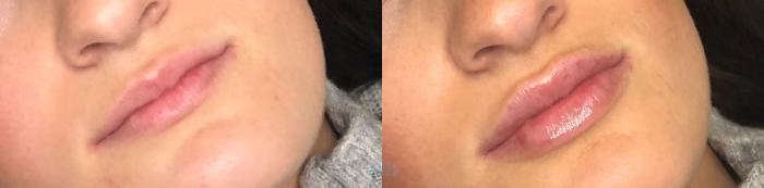 Before & After Juvéderm® & Restylane® Case 40 Front View in Charlotte, NC