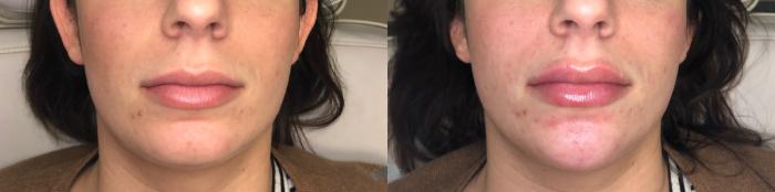 Before & After Juvéderm® & Restylane® Case 41 Front View in Charlotte, NC