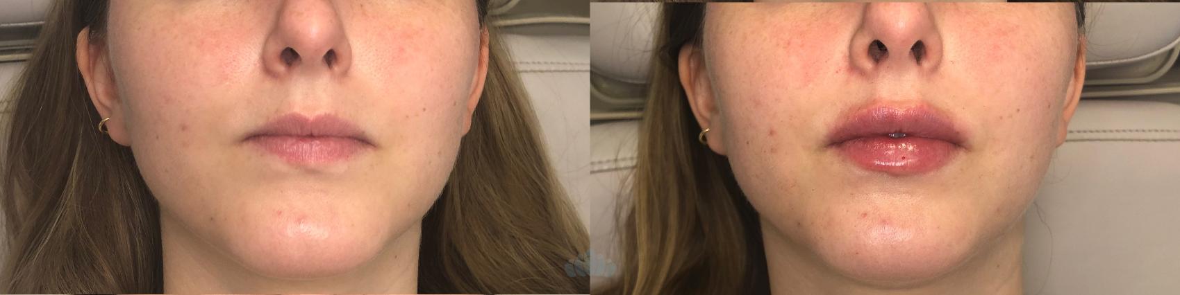 Before & After Juvéderm® & Restylane® Case 42 Front View in Charlotte, NC