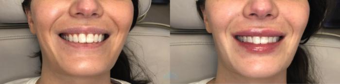 Before & After Juvéderm® & Restylane® Case 44 Front - 2nd view View in Charlotte, NC