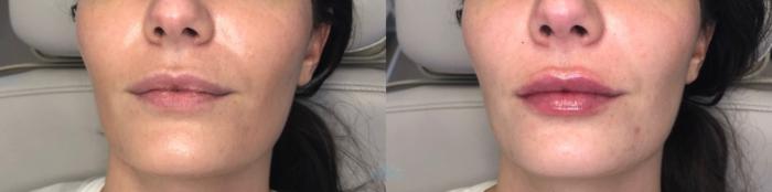 Before & After Juvéderm® & Restylane® Case 44 Front View in Charlotte, NC