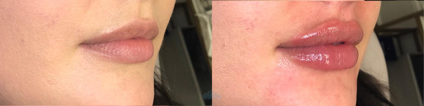 Before & After Juvéderm® & Restylane® Case 45 Right Oblique View in Charlotte, NC