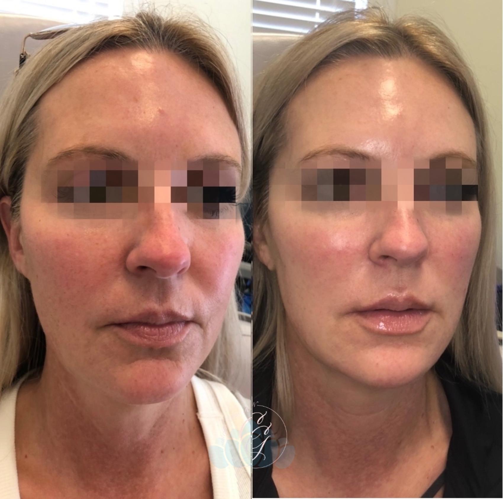 Before & After Juvéderm® & Restylane® Case 46 Right Oblique View in Charlotte, NC