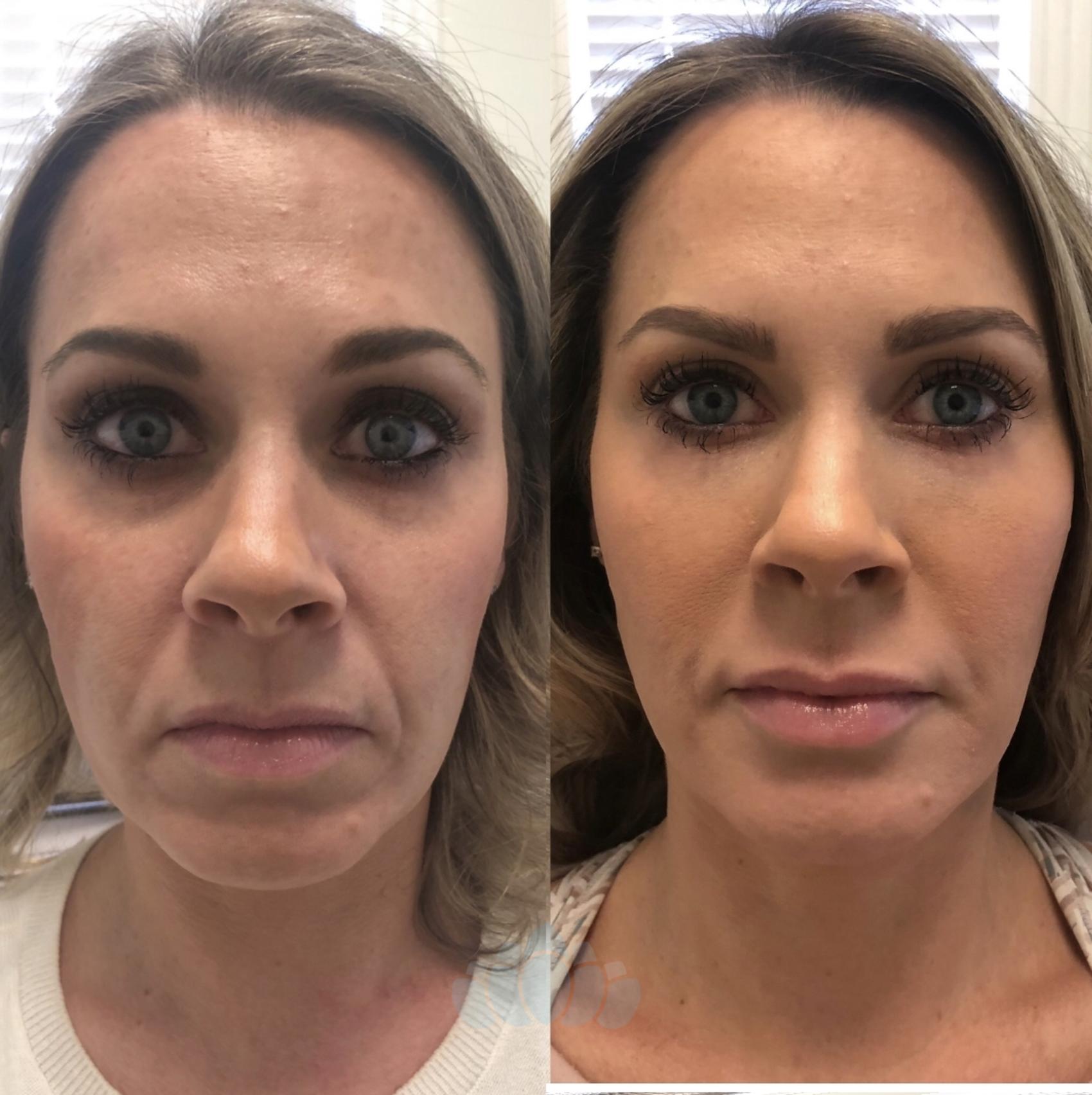 Before & After Juvéderm® & Restylane® Case 47 Front View in Charlotte, NC