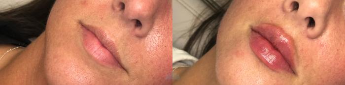 Before & After Juvéderm® & Restylane® Case 48 Front - 2nd view View in Charlotte, NC