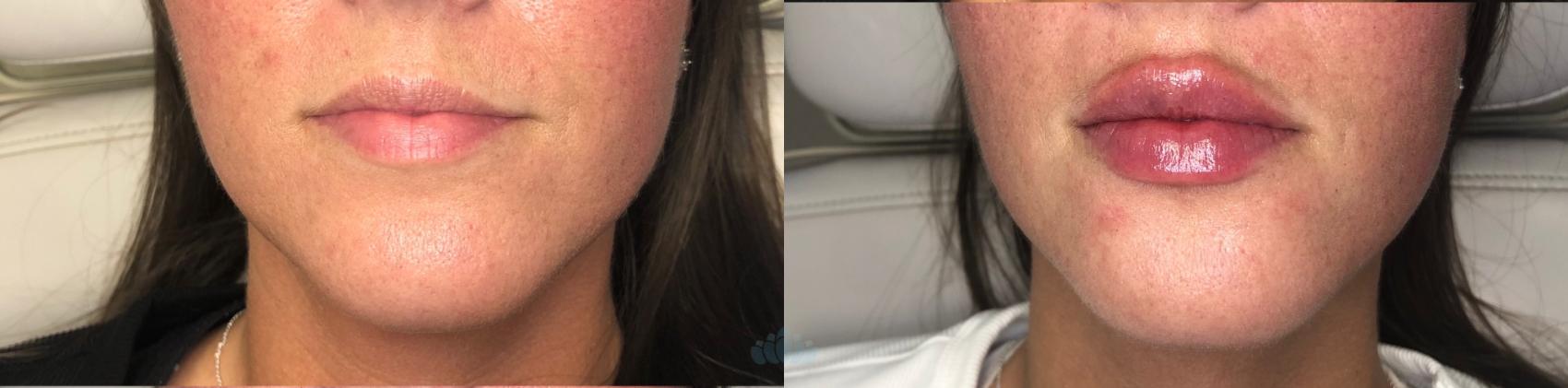 Before & After Juvéderm® & Restylane® Case 48 Front View in Charlotte, NC