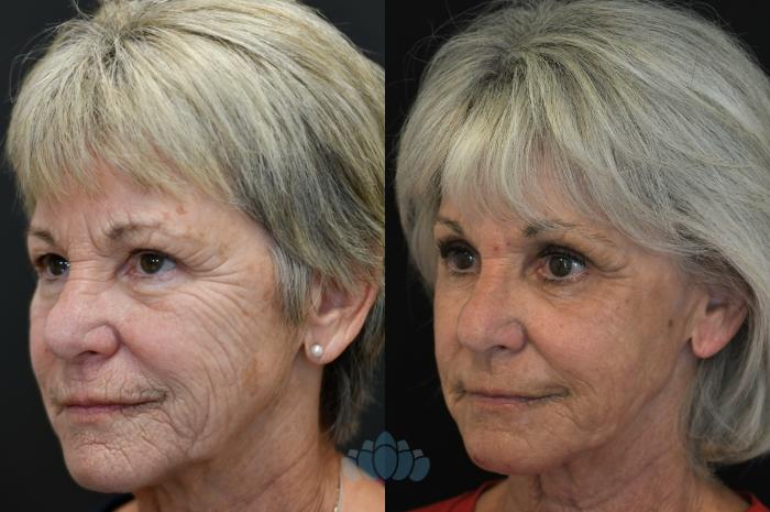 Before & After Laser resurfacing Case 124 Left Oblique View in Charlotte, NC