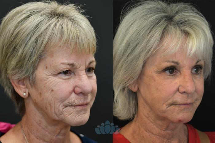 Before & After Laser resurfacing Case 124 Left Side View in Charlotte, NC
