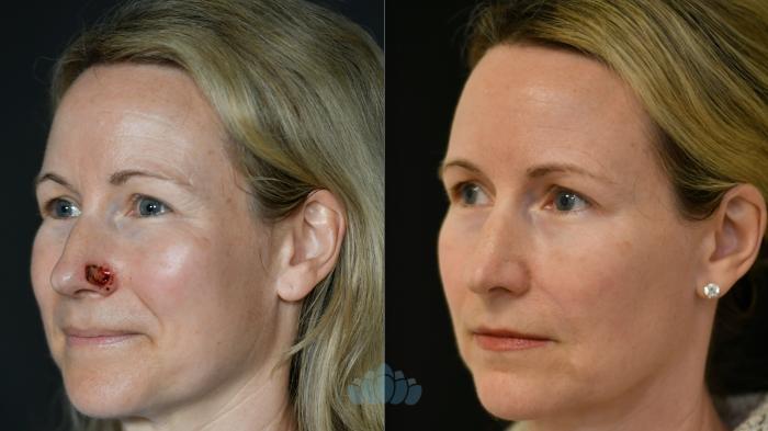 Before & After Mohs & Skin Cancer Surgery Case 118 Left Side View in Charlotte, NC
