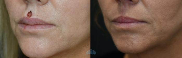 Before & After Mohs & Skin Cancer Surgery Case 120 Left Oblique View in Charlotte, NC