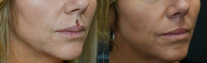 Before & After Mohs & Skin Cancer Surgery Case 120 Right Oblique View in Charlotte, NC