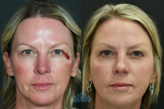 Before & After Mohs & Skin Cancer Surgery Case 121 Front View in Charlotte, NC