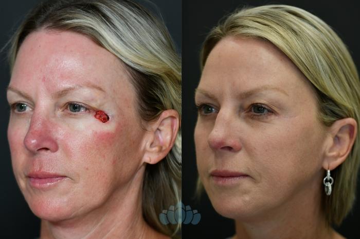 Before & After Mohs & Skin Cancer Surgery Case 121 Left Oblique View in Charlotte, NC