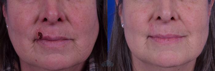 Before & After Mohs & Skin Cancer Surgery Case 3 Front View in Charlotte, NC