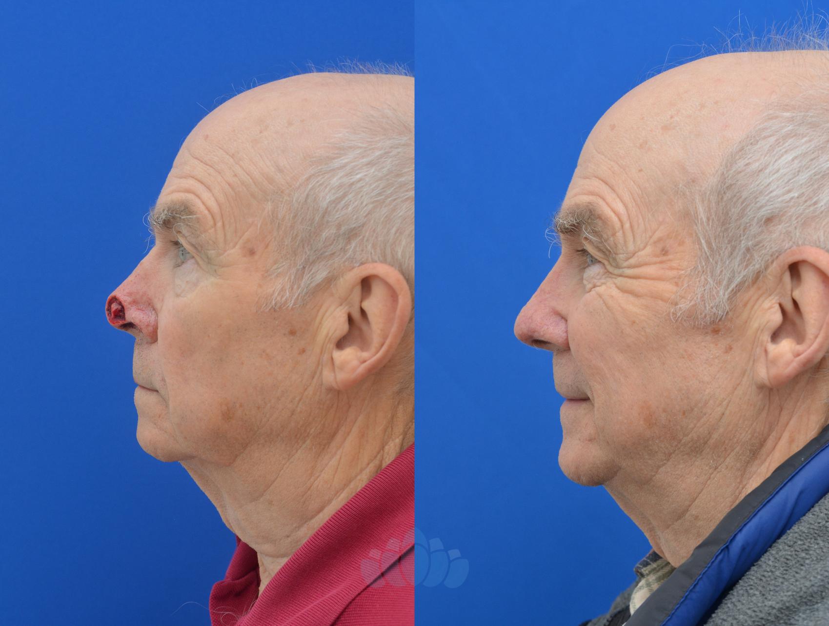Before & After Mohs & Skin Cancer Surgery Case 4 Left Side View in Charlotte, NC