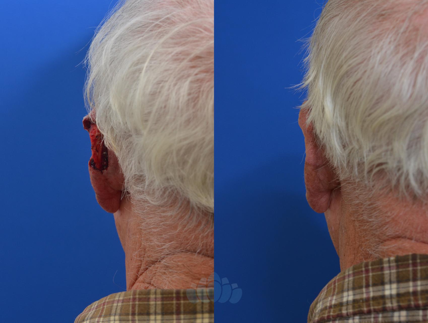 Before & After Mohs & Skin Cancer Surgery Case 5 Back View in Charlotte, NC