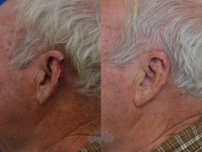 Before & After Mohs & Skin Cancer Surgery Case 5 Left Side View in Charlotte, NC