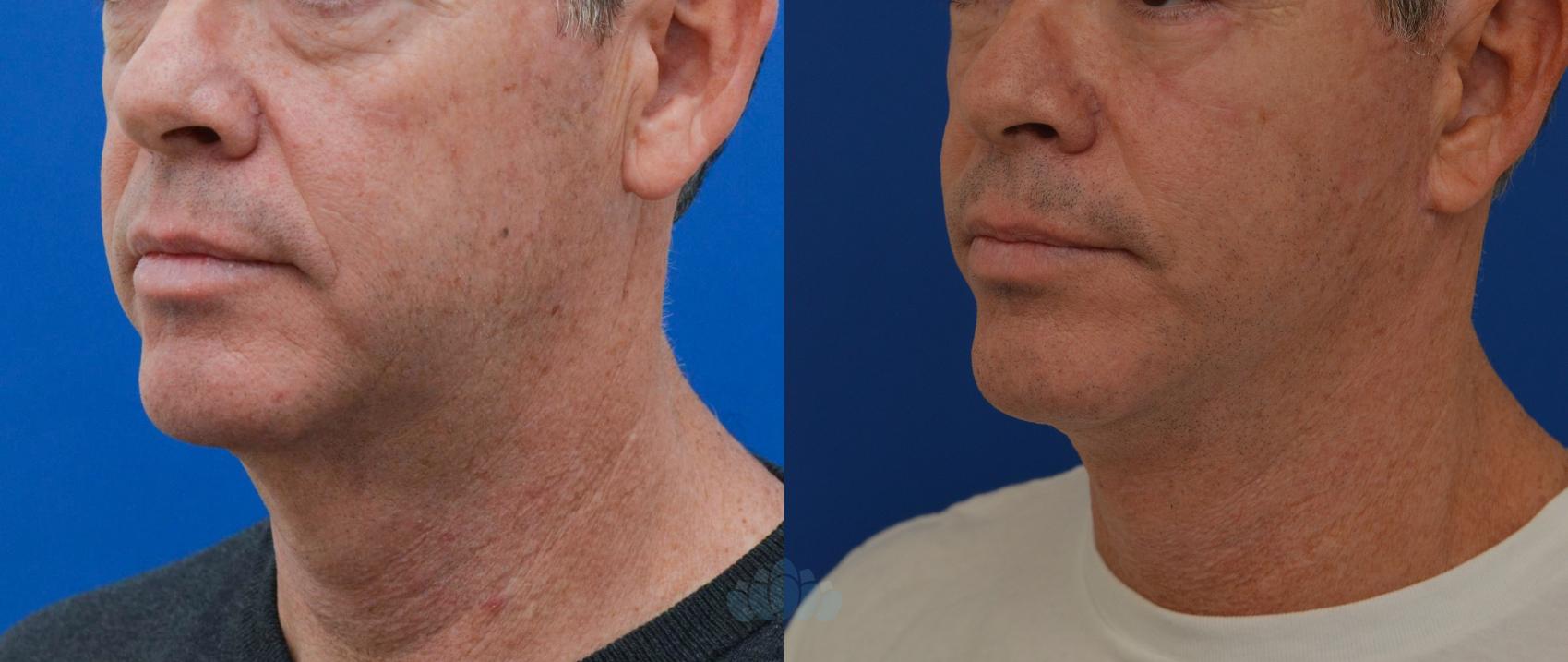 Before & After Neck Lift Case 13 Left Oblique View in Charlotte, NC