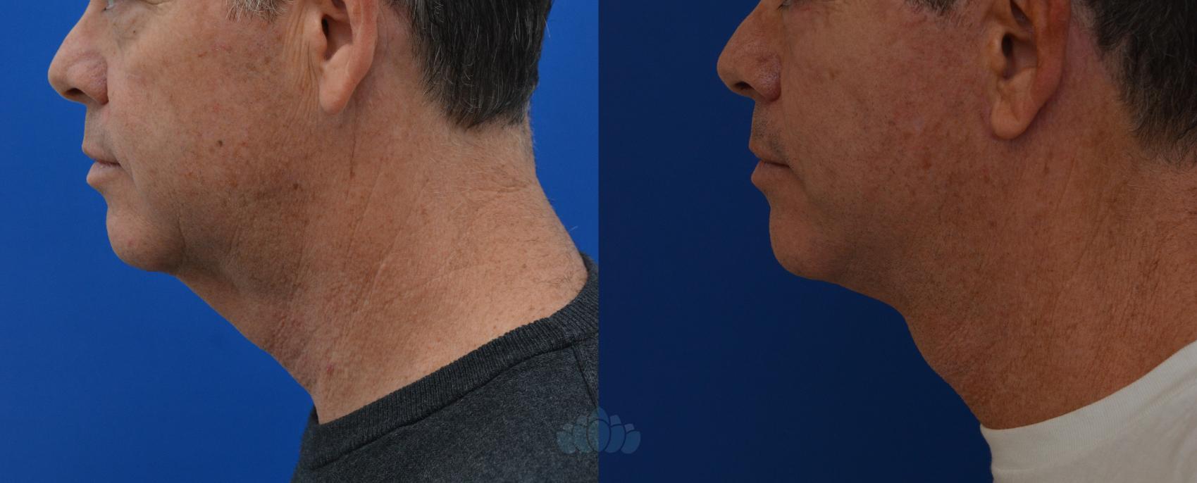 Before & After Neck Lift Case 13 Left Side View in Charlotte, NC