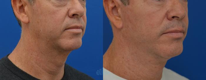 Before & After Neck Lift Case 13 Right Oblique View in Charlotte, NC