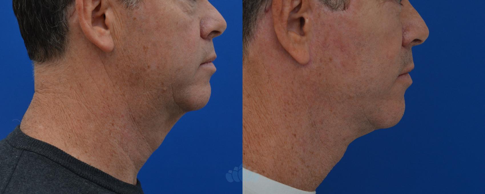 Before & After Neck Lift Case 13 Right Side View in Charlotte, NC