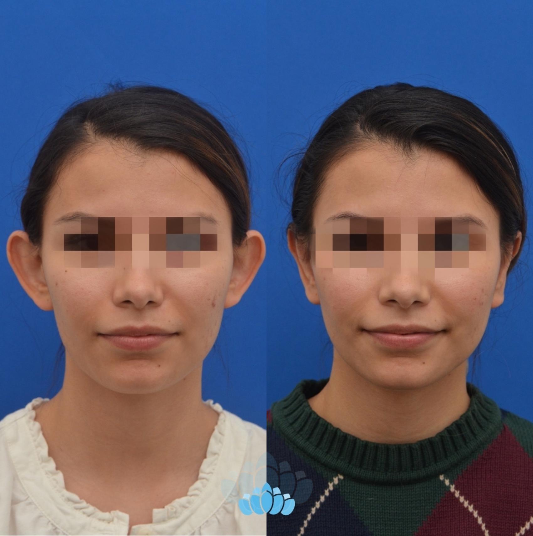 Before & After Otoplasty Case 23 Front View in Charlotte, NC