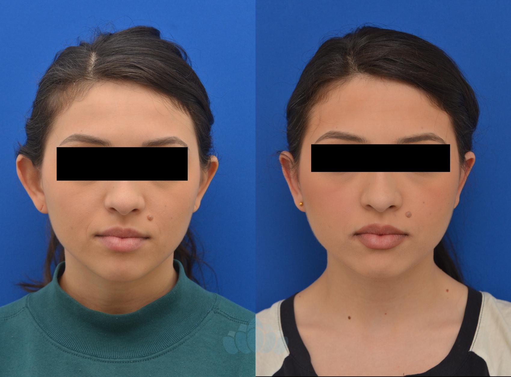 Before & After Otoplasty Case 7 Front View in Charlotte, NC